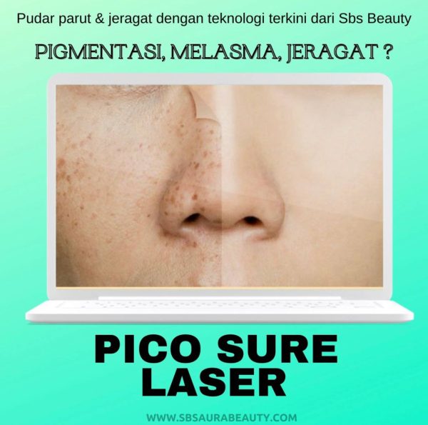 Pico Sure Laser