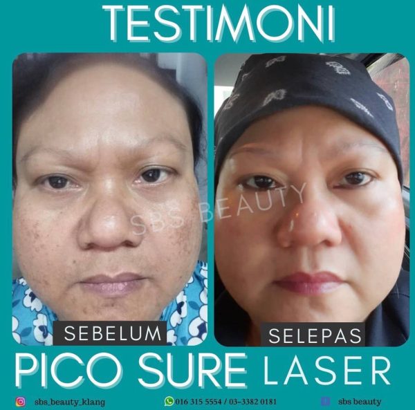 Pico Sure Laser - Image 5
