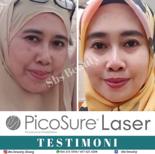 Pico Sure Laser - Image 3
