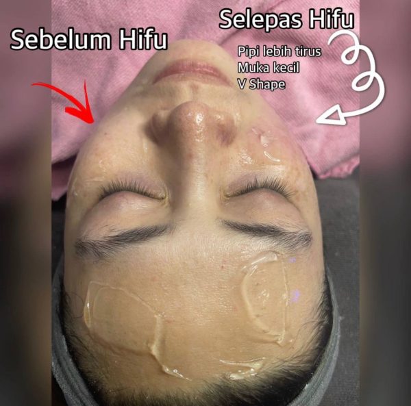 Hifu Ultheraphy Hifu - Image 3