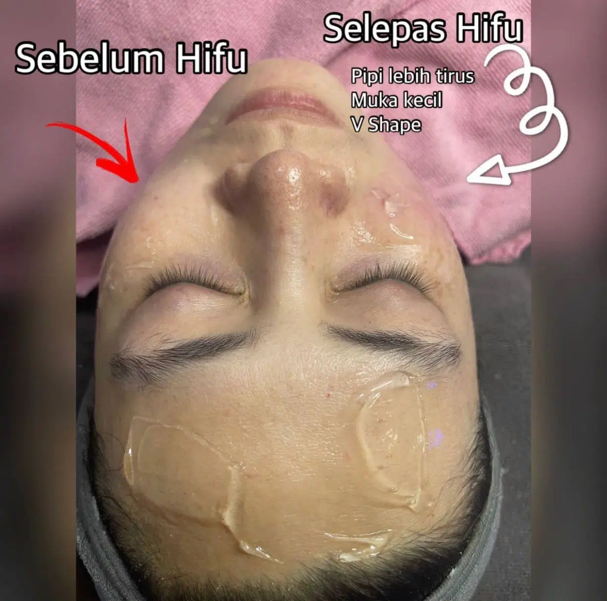 Hifu Ultheraphy Hifu - Image 3