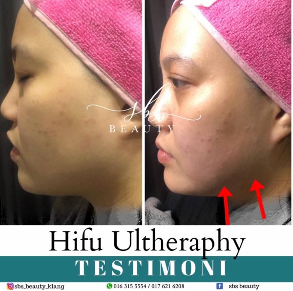 Hifu Ultheraphy Hifu - Image 5