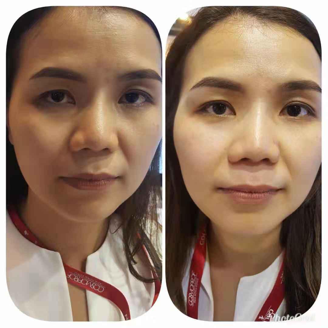 Rawatan Kiss Eye - Image 2